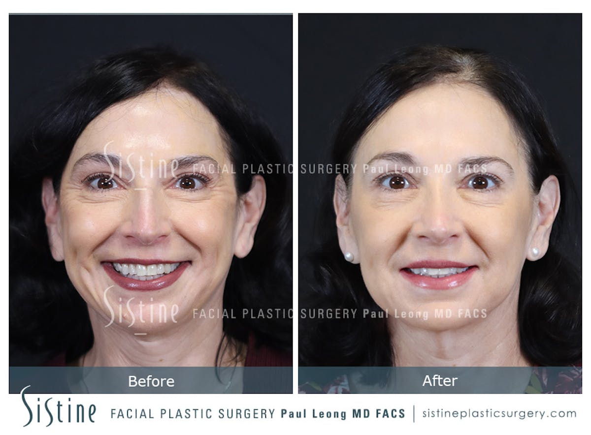 Rhinoplasty Before & After Gallery - Patient 393037 - Image 2