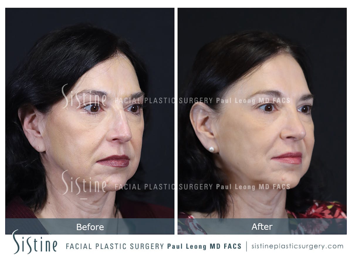Rhinoplasty Before & After Gallery - Patient 393037 - Image 3