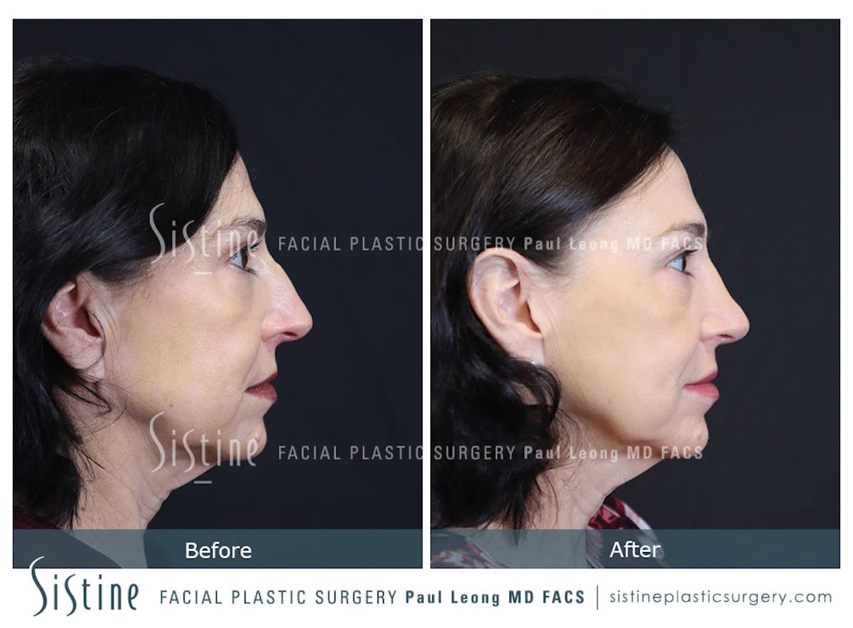 Rhinoplasty Before & After Gallery - Patient 393037 - Image 4