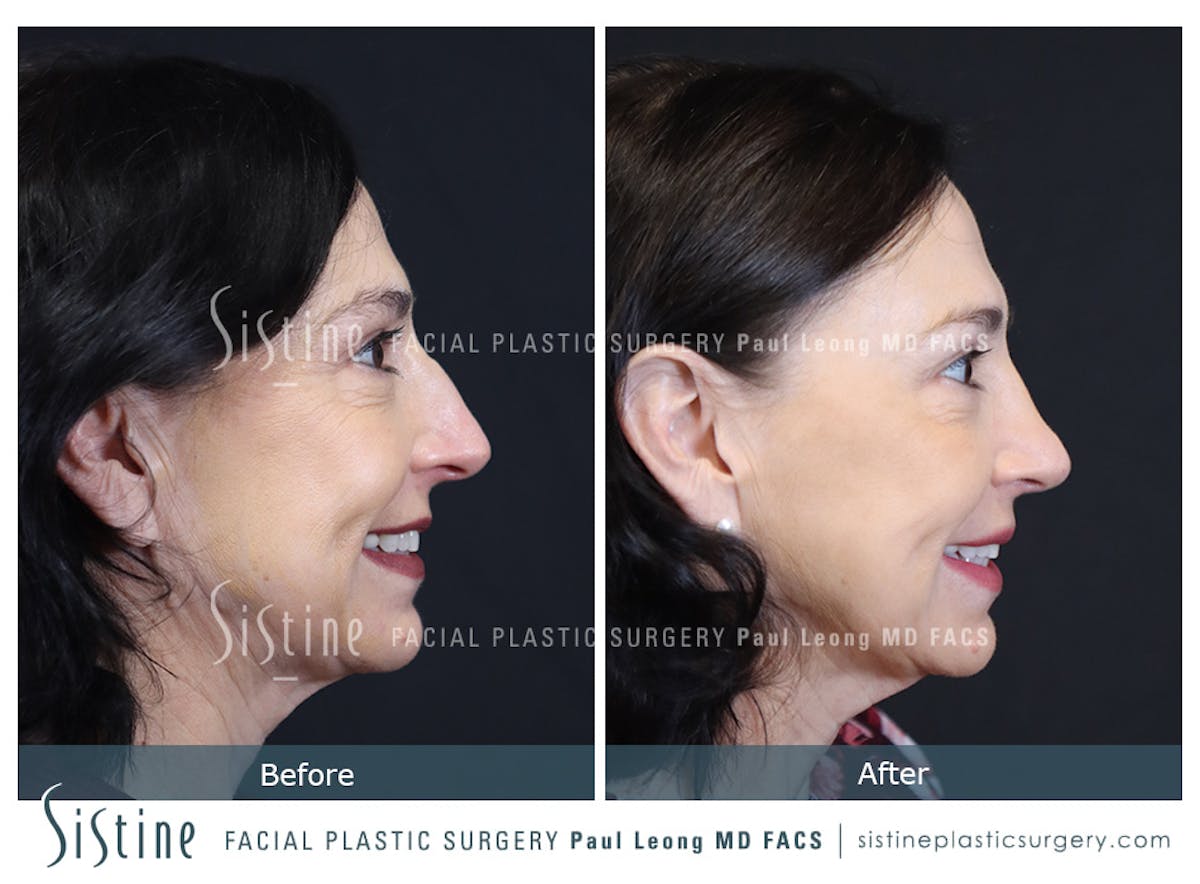 Rhinoplasty Before & After Gallery - Patient 393037 - Image 5