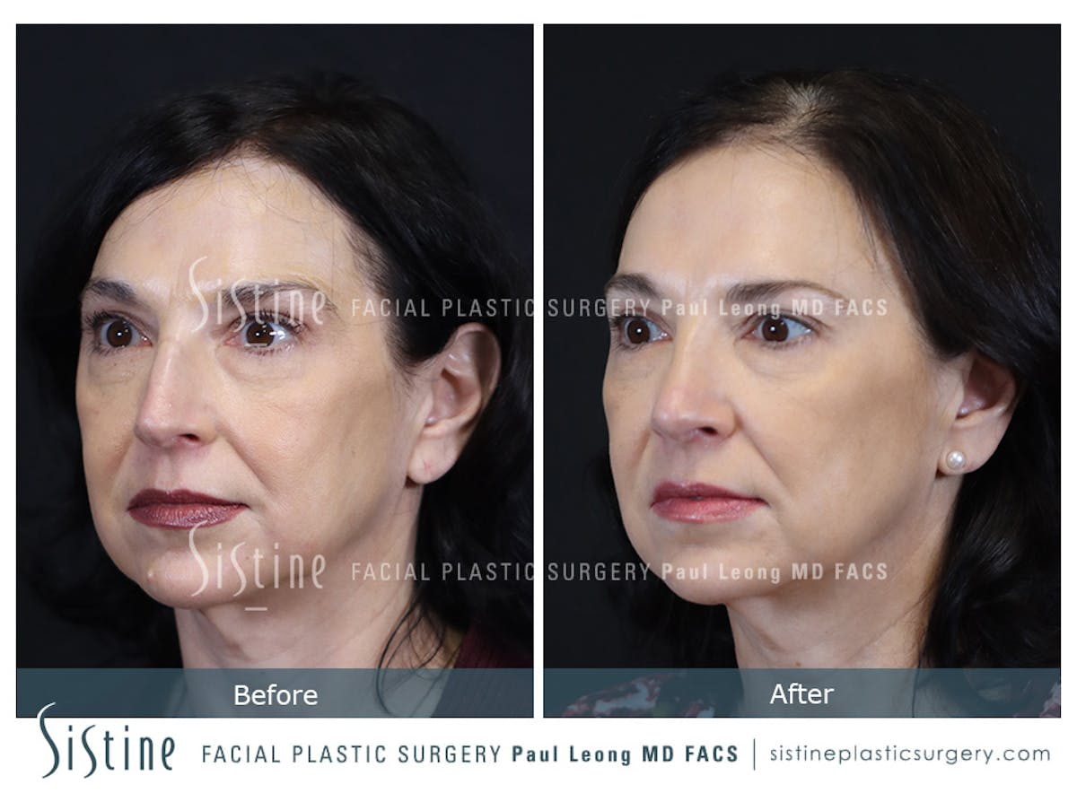 Rhinoplasty Before & After Gallery - Patient 393037 - Image 6