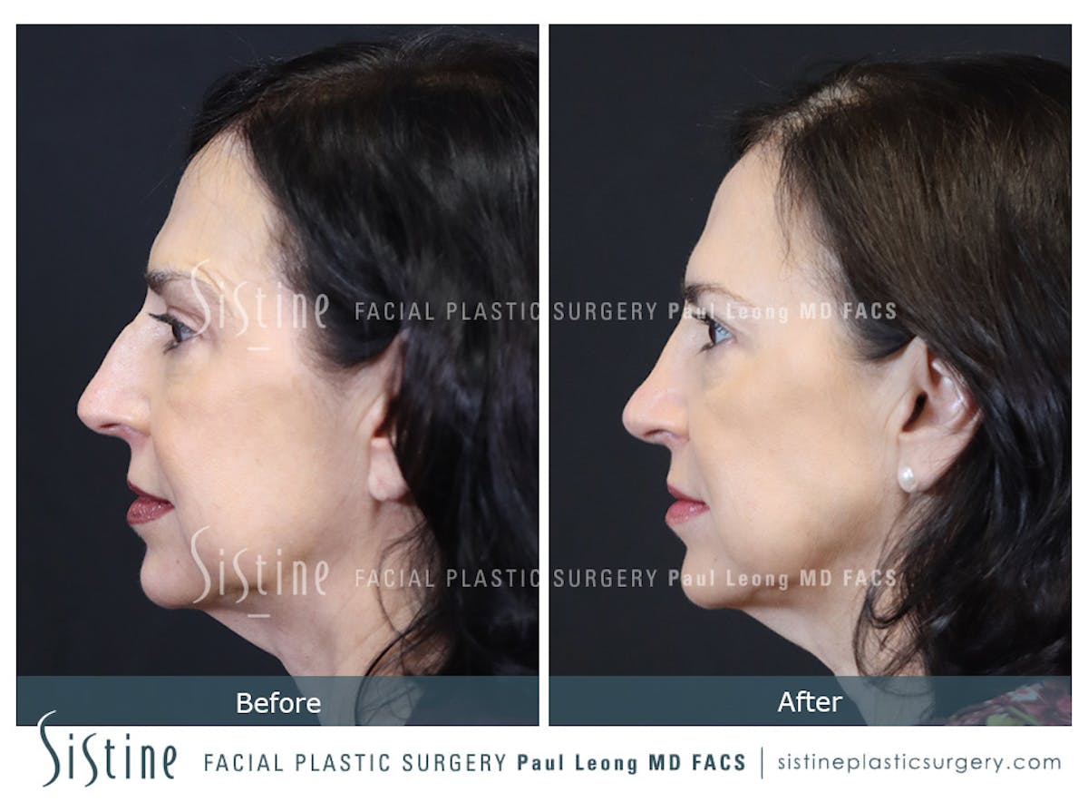Rhinoplasty Before & After Gallery - Patient 393037 - Image 7