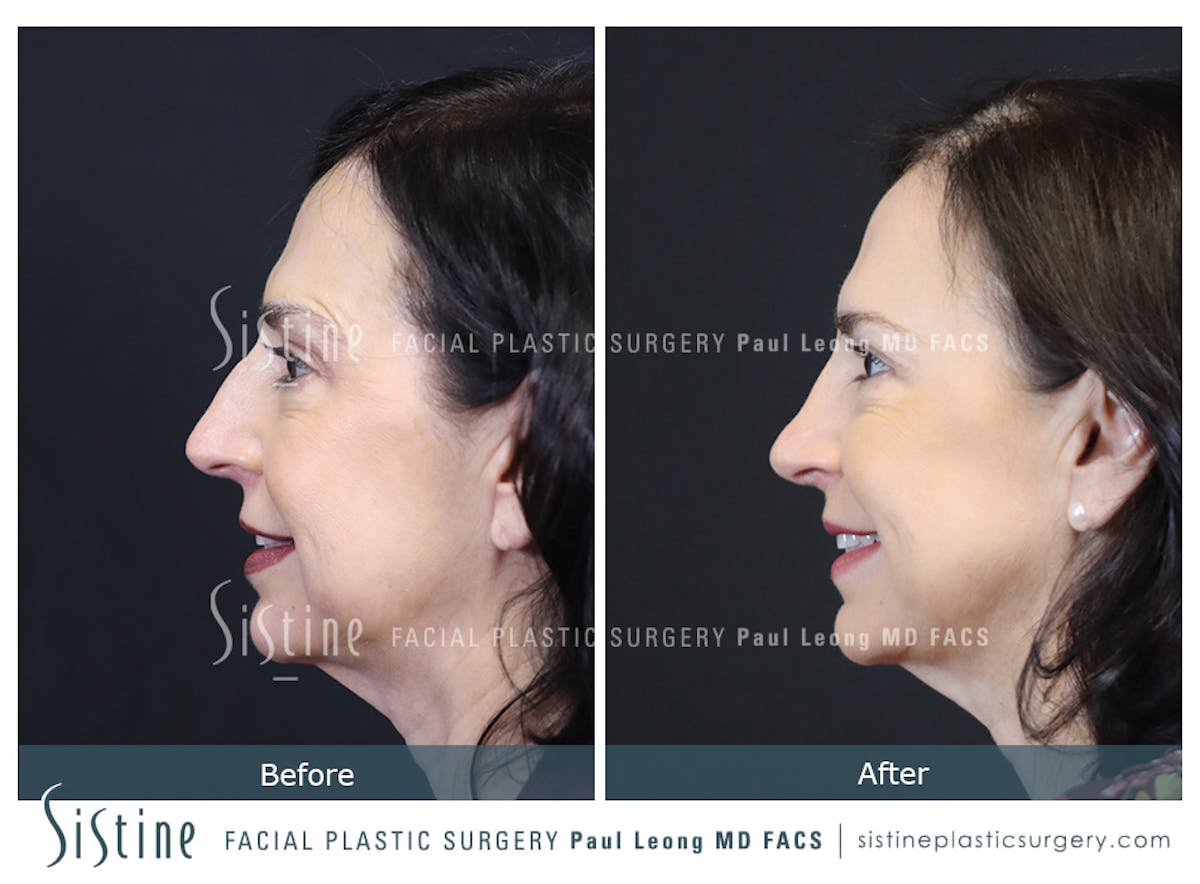 Rhinoplasty Before & After Gallery - Patient 393037 - Image 8