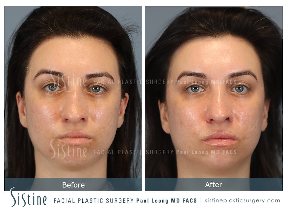 Rhinoplasty Before & After Gallery - Patient 107595 - Image 1