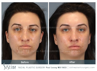 Rhinoplasty Before & After Gallery - Patient 107595 - Image 1