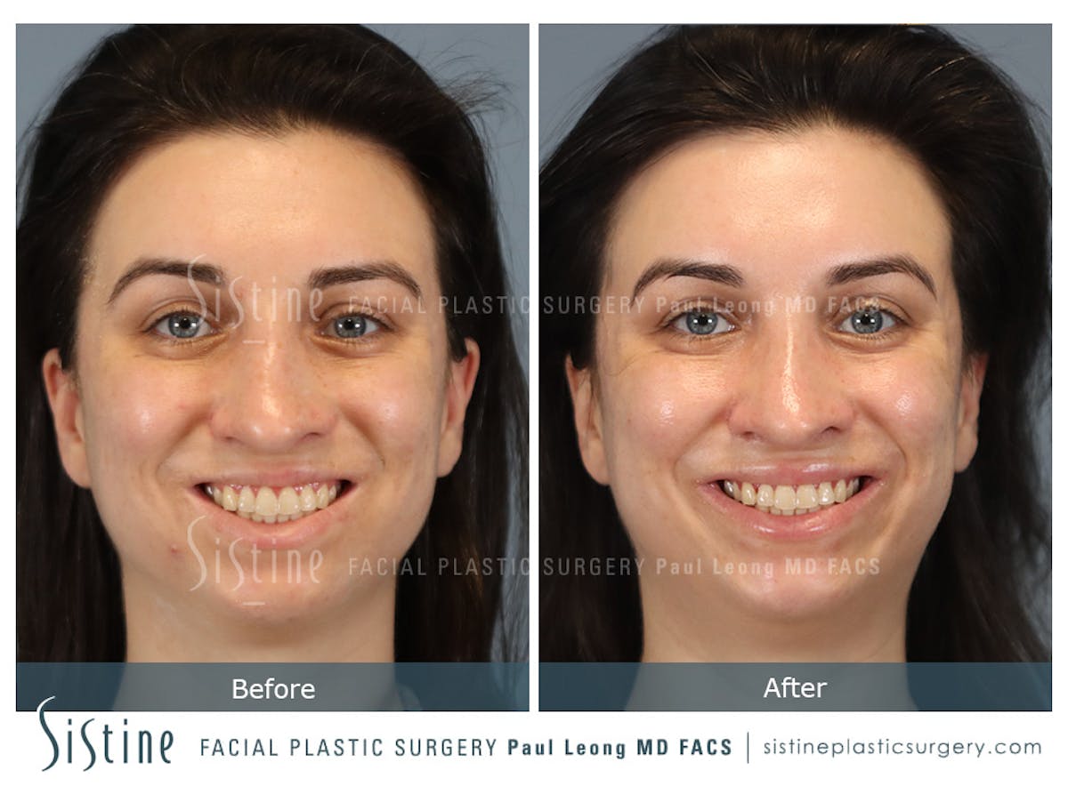 Rhinoplasty Before & After Gallery - Patient 107595 - Image 2