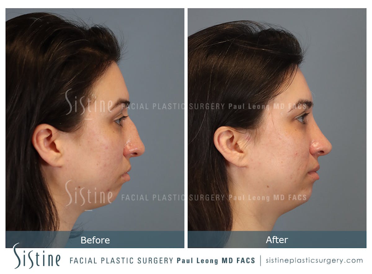 Rhinoplasty Before & After Gallery - Patient 107595 - Image 4
