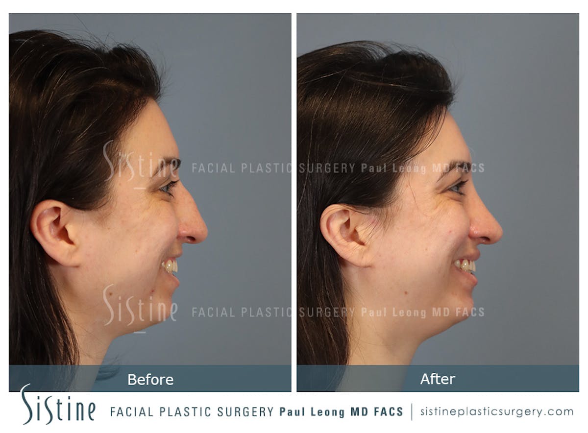 Rhinoplasty Before & After Gallery - Patient 107595 - Image 5
