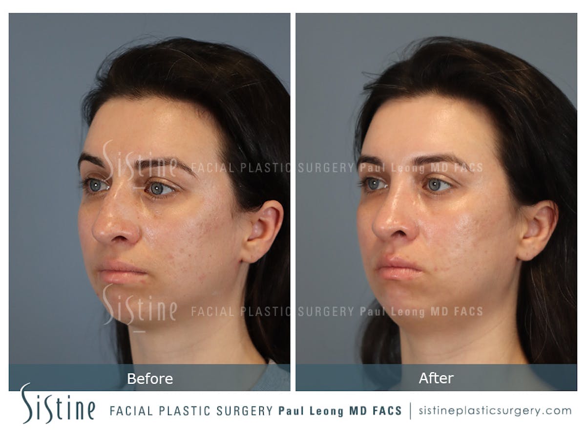 Rhinoplasty Before & After Gallery - Patient 107595 - Image 6