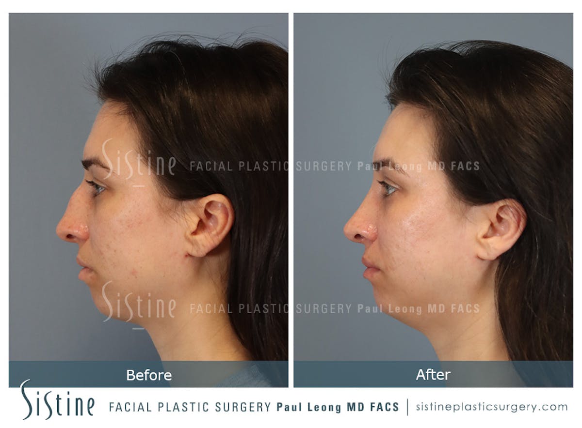 Rhinoplasty Before & After Gallery - Patient 107595 - Image 7