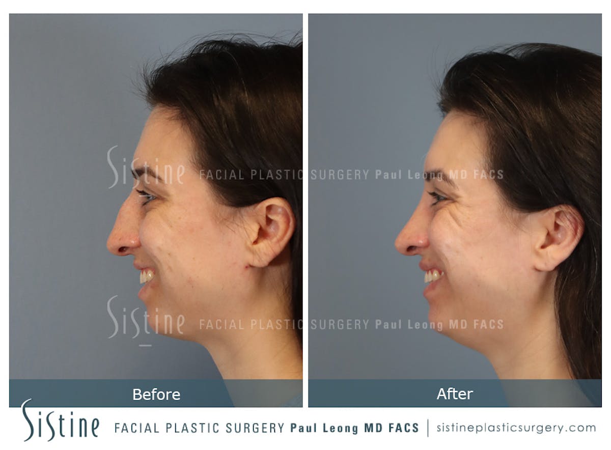 Rhinoplasty Before & After Gallery - Patient 107595 - Image 8
