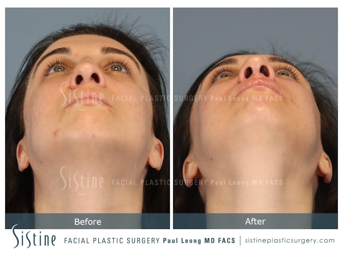 Rhinoplasty Before & After Gallery - Patient 107595 - Image 9