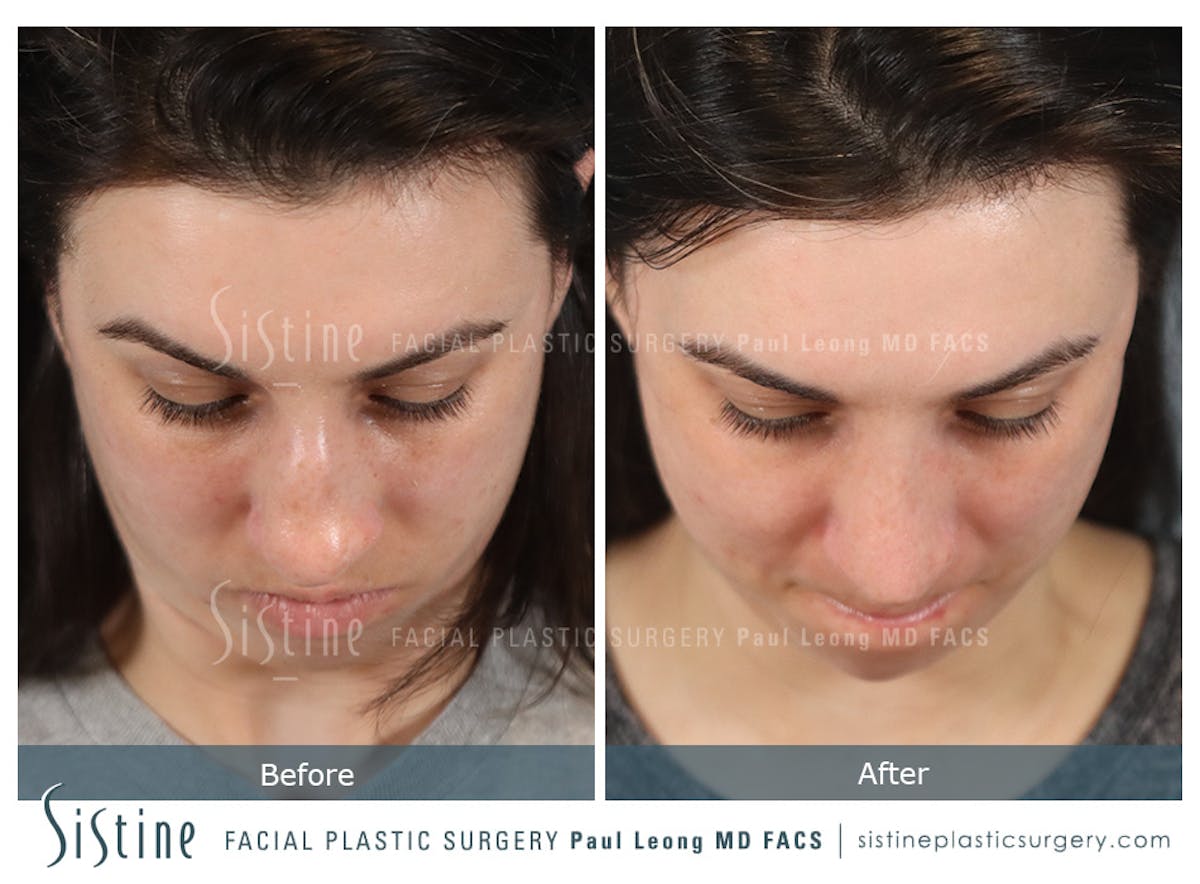 Rhinoplasty Before & After Gallery - Patient 107595 - Image 10