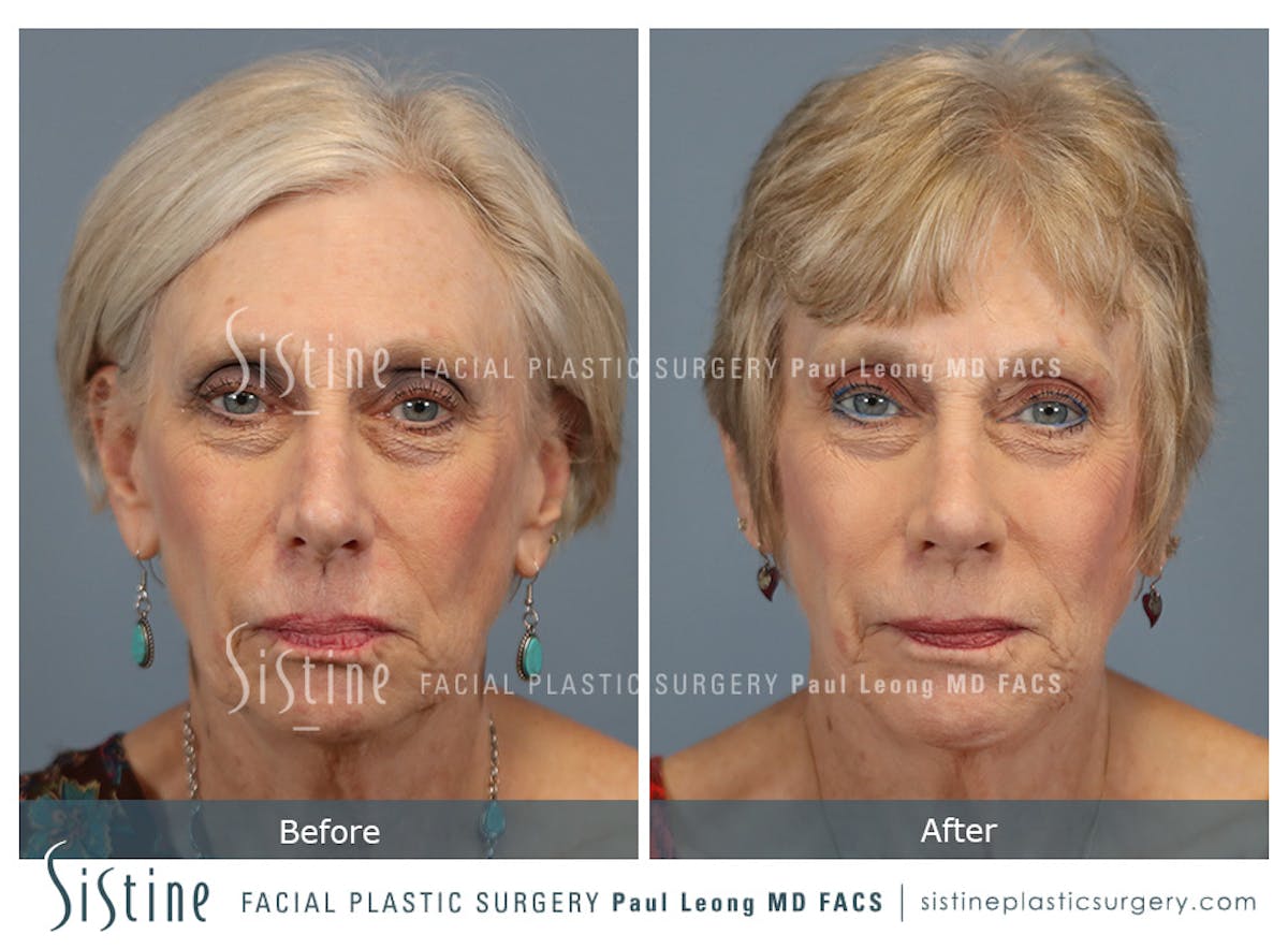 Rhinoplasty Before & After Gallery - Patient 202484 - Image 1