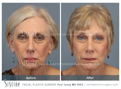 Rhinoplasty Before & After Gallery - Patient 202484 - Image 1