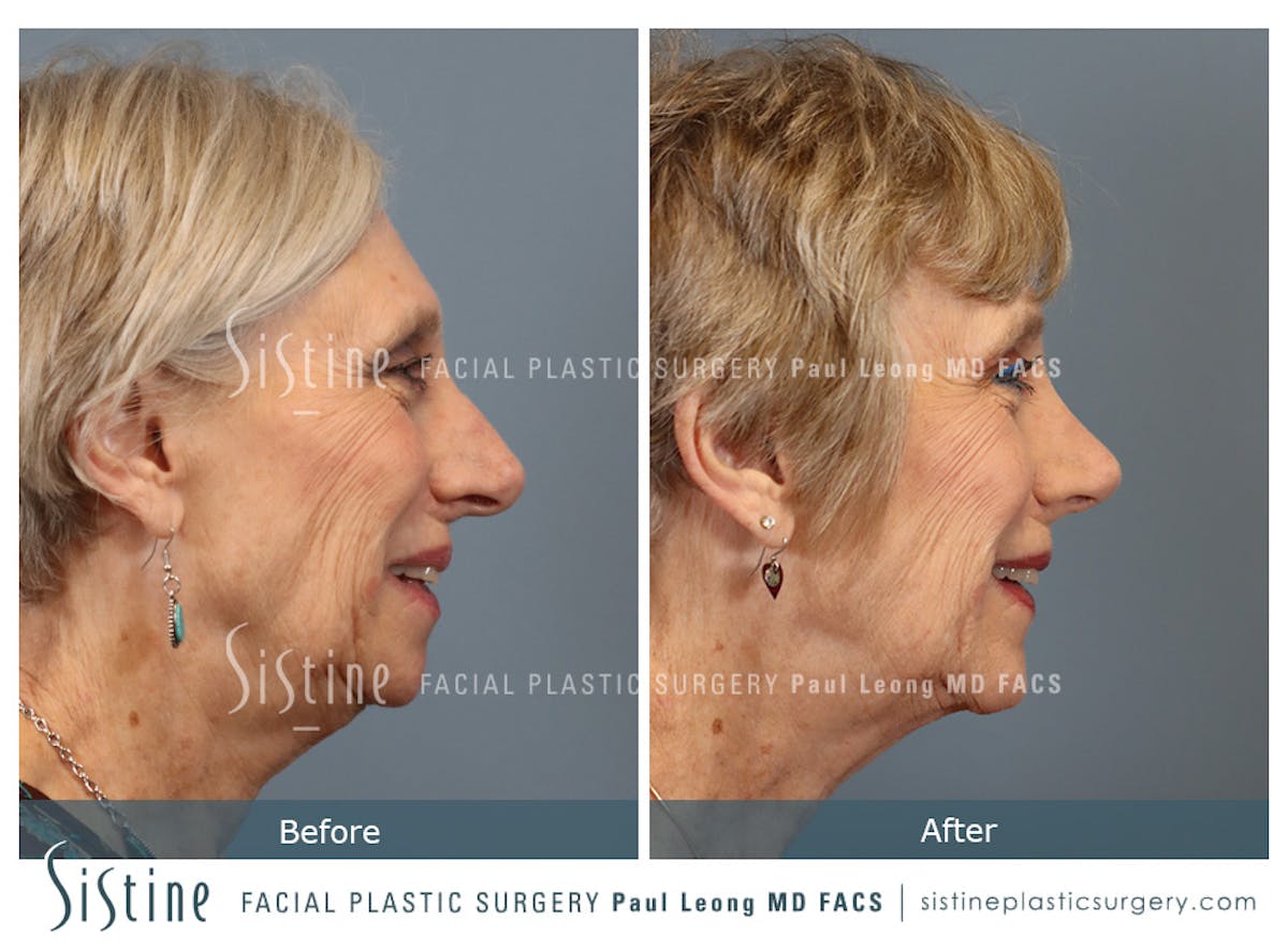 Rhinoplasty Before & After Gallery - Patient 202484 - Image 4