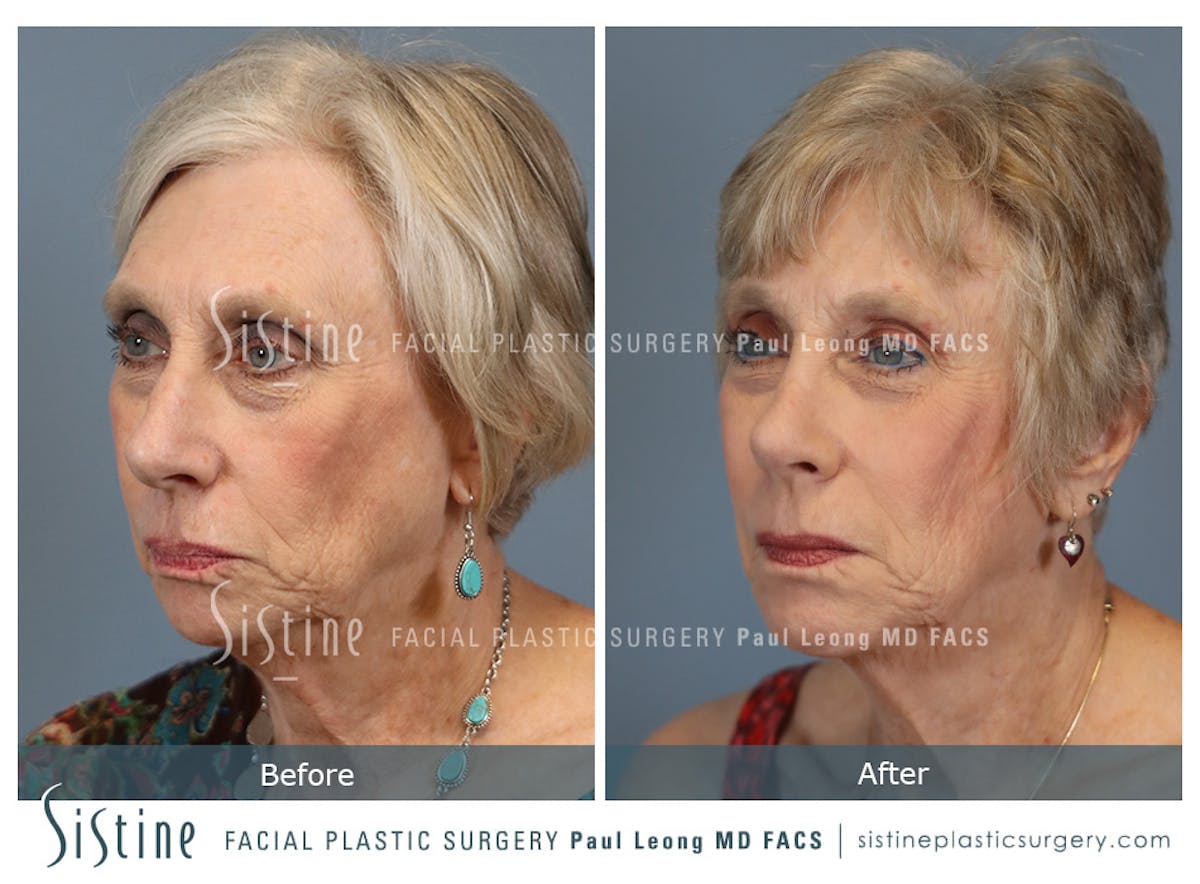 Rhinoplasty Before & After Gallery - Patient 202484 - Image 5