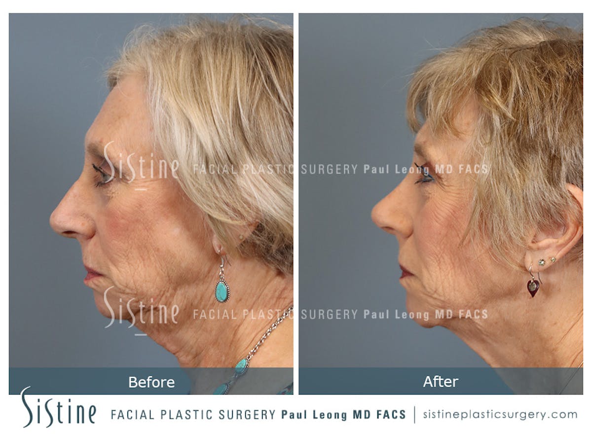Rhinoplasty Before & After Gallery - Patient 202484 - Image 6