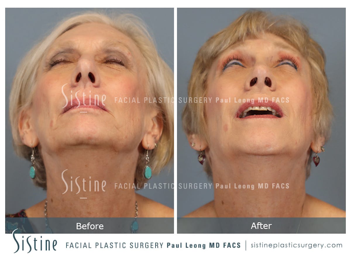 Rhinoplasty Before & After Gallery - Patient 202484 - Image 7