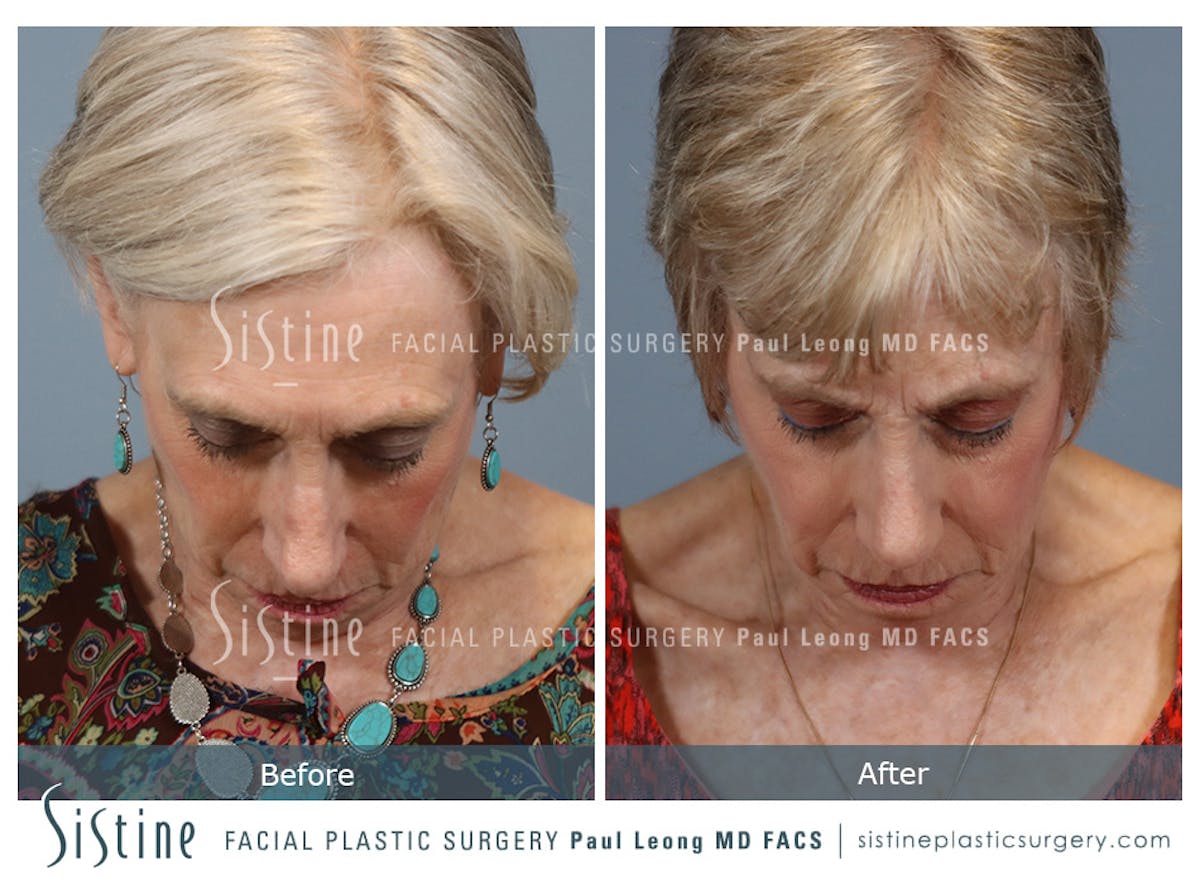 Rhinoplasty Before & After Gallery - Patient 202484 - Image 8