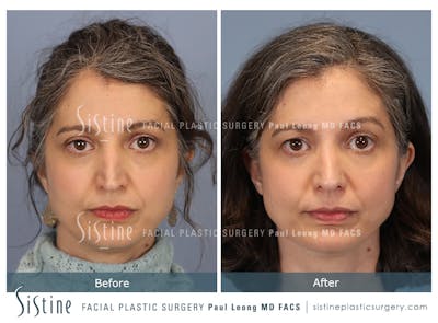 Rhinoplasty Before & After Gallery - Patient 140196 - Image 1