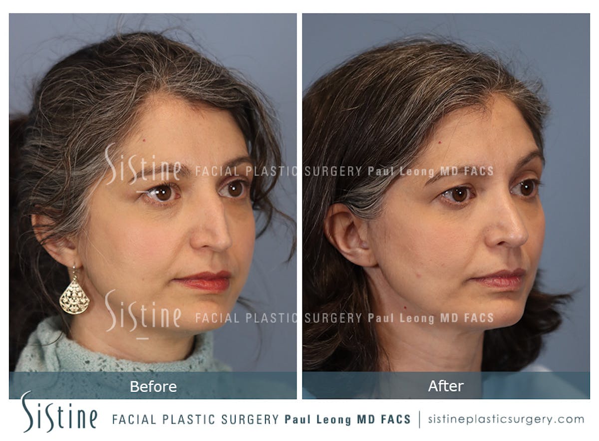 Rhinoplasty Before & After Gallery - Patient 140196 - Image 2