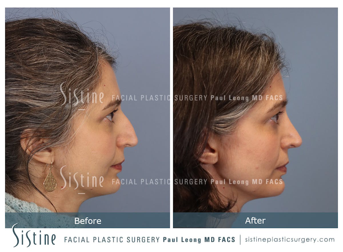 Rhinoplasty Before & After Gallery - Patient 140196 - Image 3