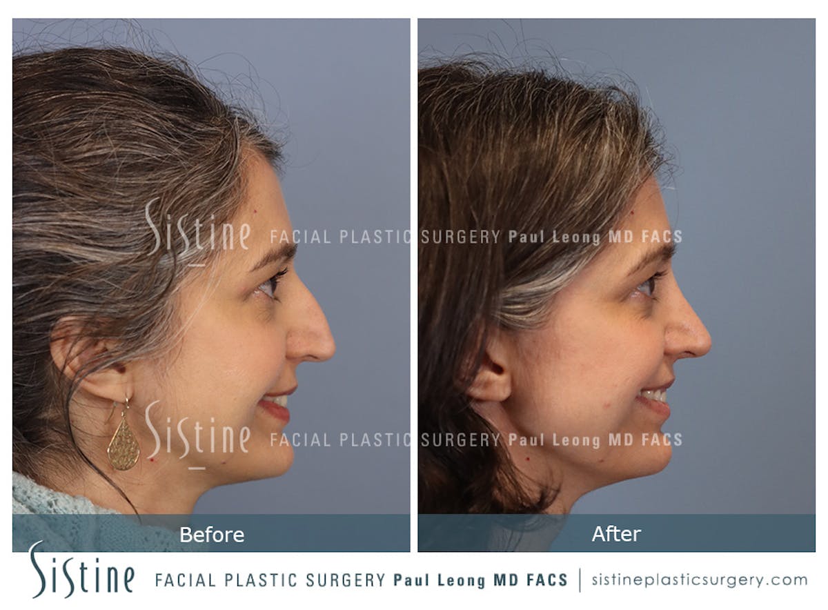 Rhinoplasty Before & After Gallery - Patient 140196 - Image 4