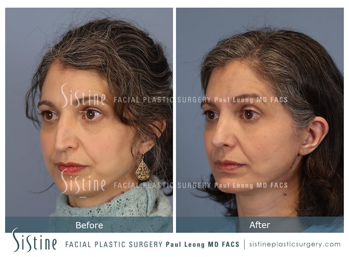 Rhinoplasty Before & After Gallery - Patient 140196 - Image 5