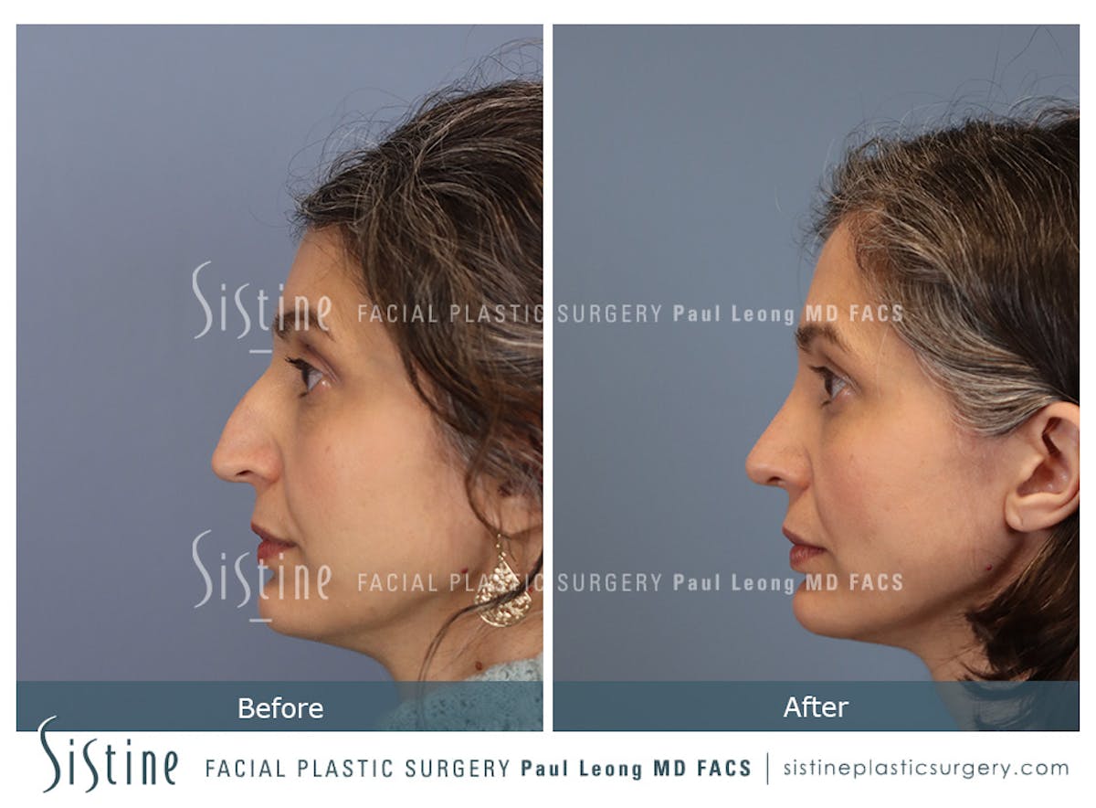 Rhinoplasty Before & After Gallery - Patient 140196 - Image 6