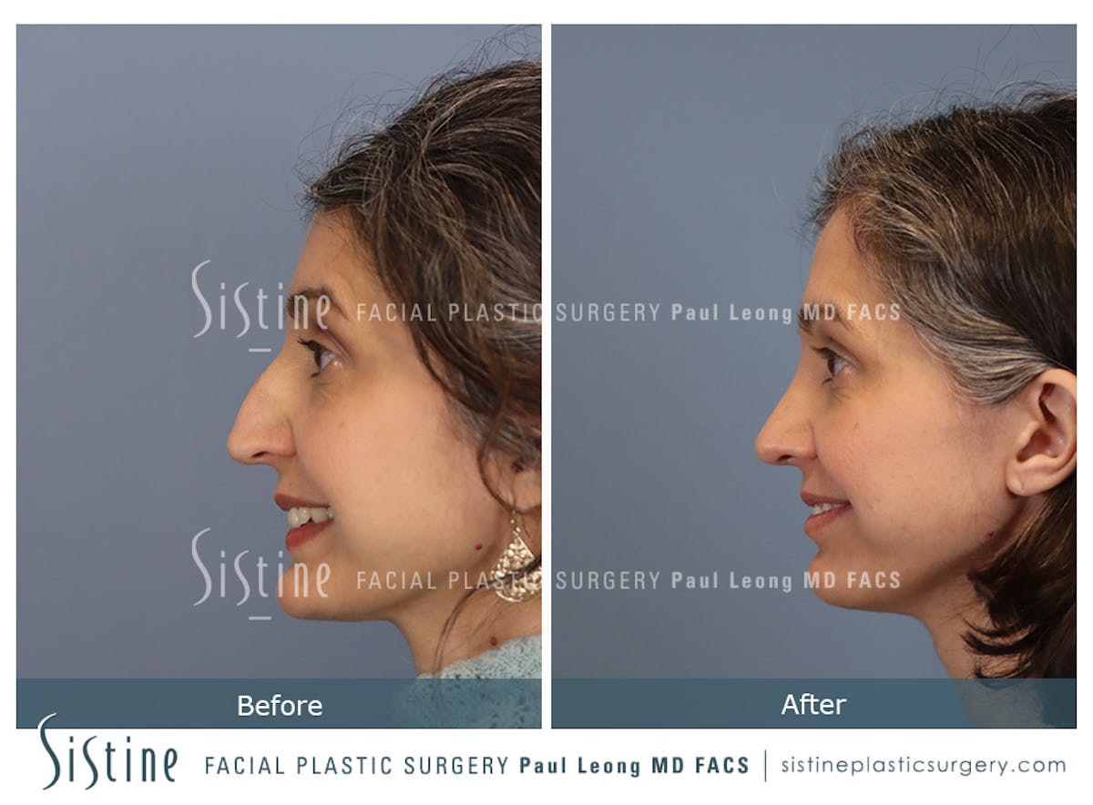 Rhinoplasty Before & After Gallery - Patient 140196 - Image 7