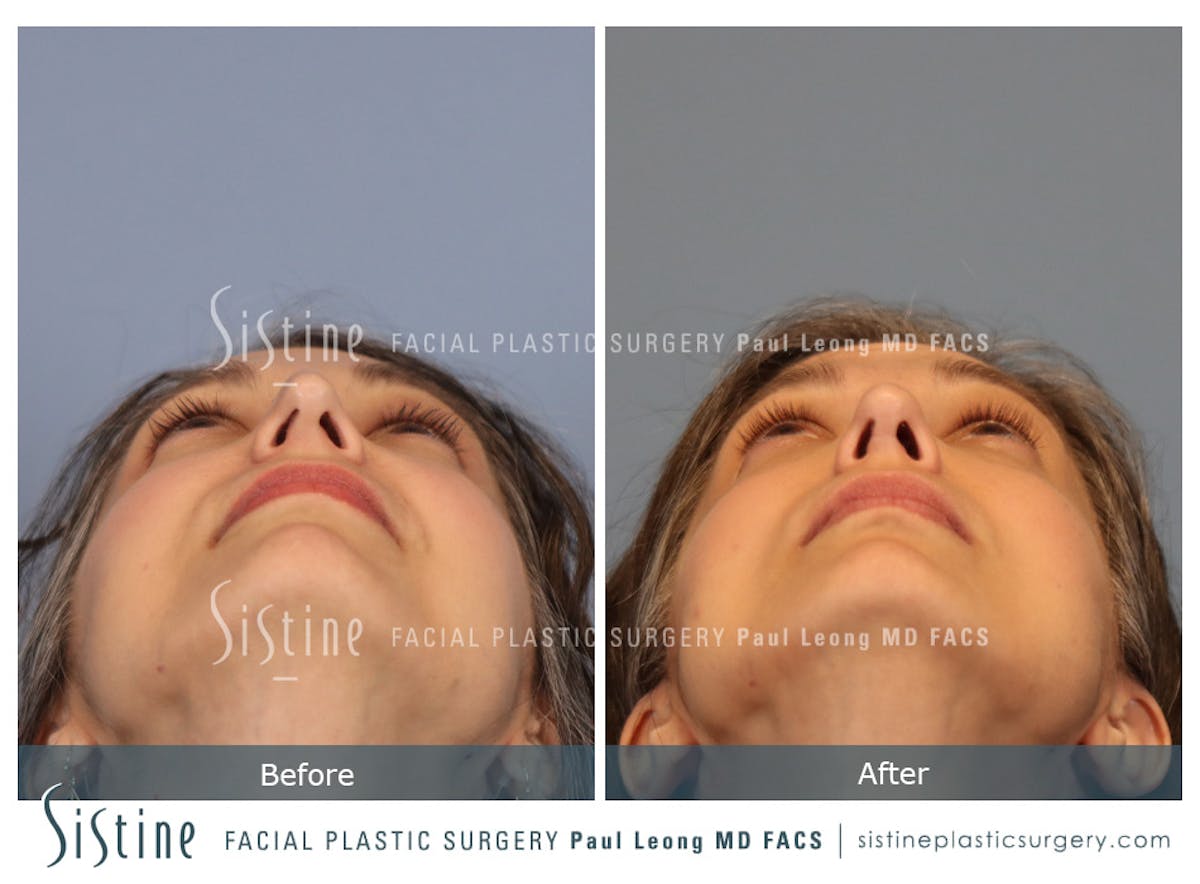 Rhinoplasty Before & After Gallery - Patient 140196 - Image 8