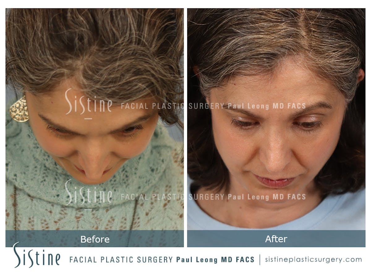 Rhinoplasty Before & After Gallery - Patient 140196 - Image 9