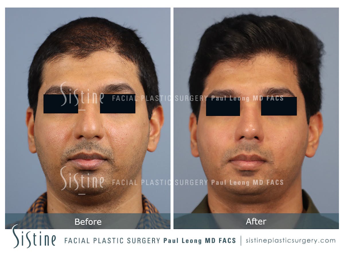 Rhinoplasty Before & After Gallery - Patient 425909 - Image 1