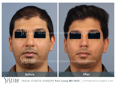 Rhinoplasty Before & After Gallery - Patient 425909 - Image 1