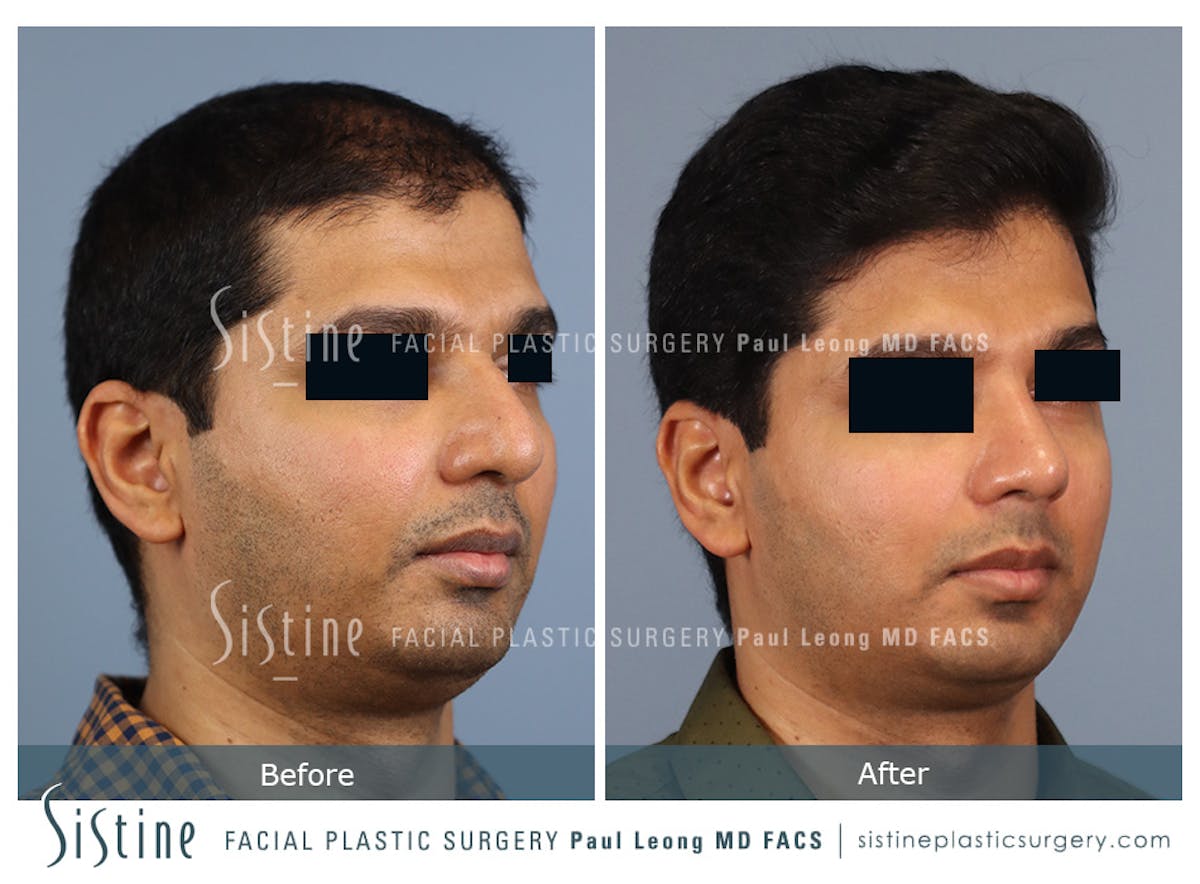 Rhinoplasty Before & After Gallery - Patient 425909 - Image 2