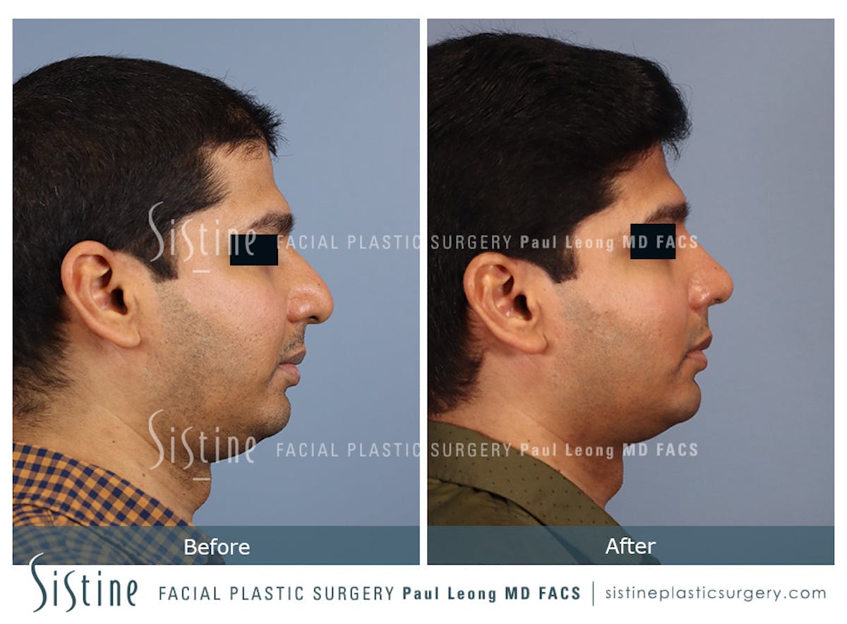 Rhinoplasty Before & After Gallery - Patient 425909 - Image 3