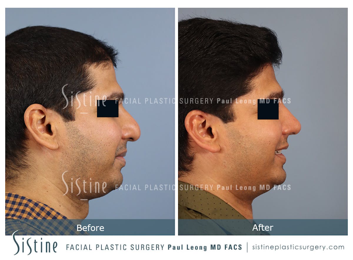 Rhinoplasty Before & After Gallery - Patient 425909 - Image 4