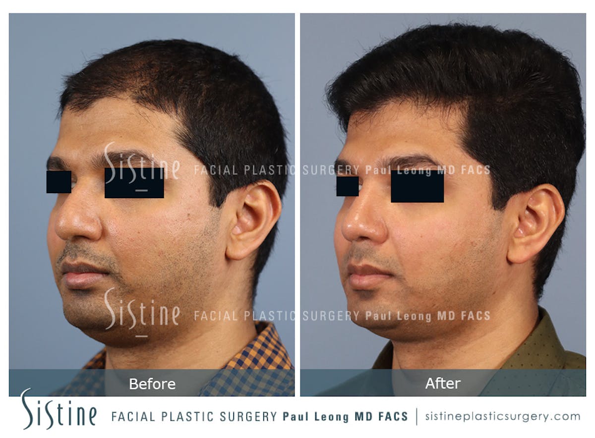 Rhinoplasty Before & After Gallery - Patient 425909 - Image 5