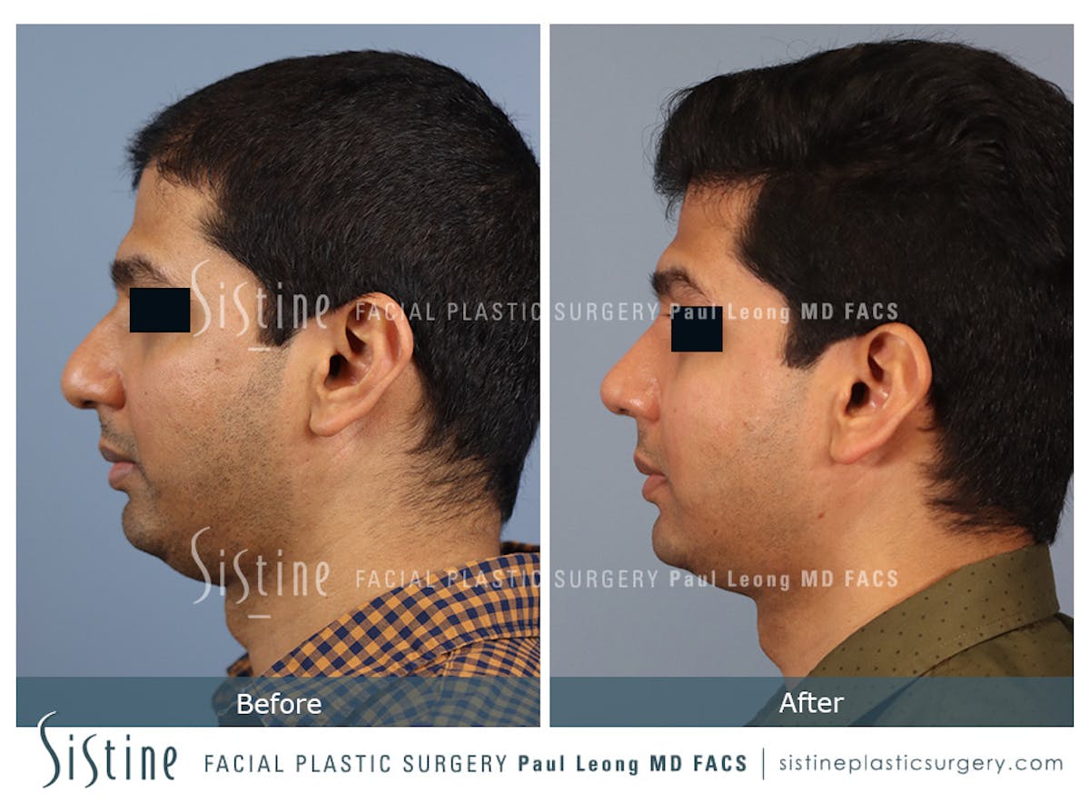 Rhinoplasty Before & After Gallery - Patient 425909 - Image 6