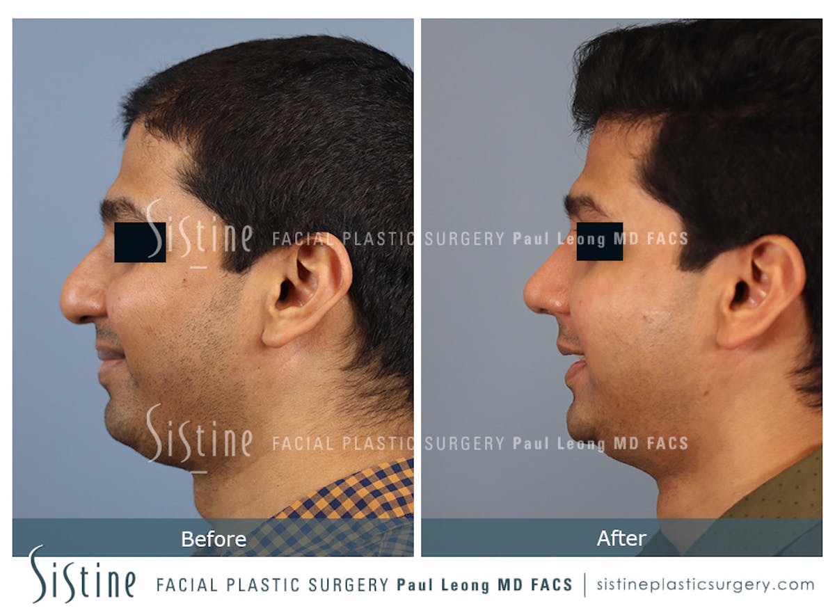 Rhinoplasty Before & After Gallery - Patient 425909 - Image 7