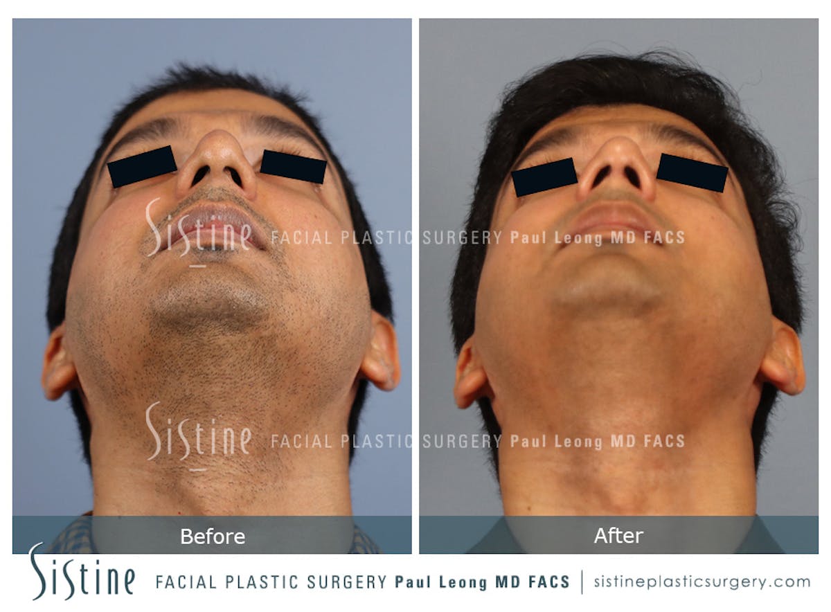 Rhinoplasty Before & After Gallery - Patient 425909 - Image 8