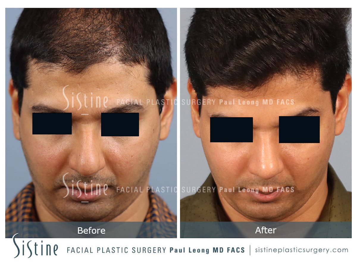 Rhinoplasty Before & After Gallery - Patient 425909 - Image 9