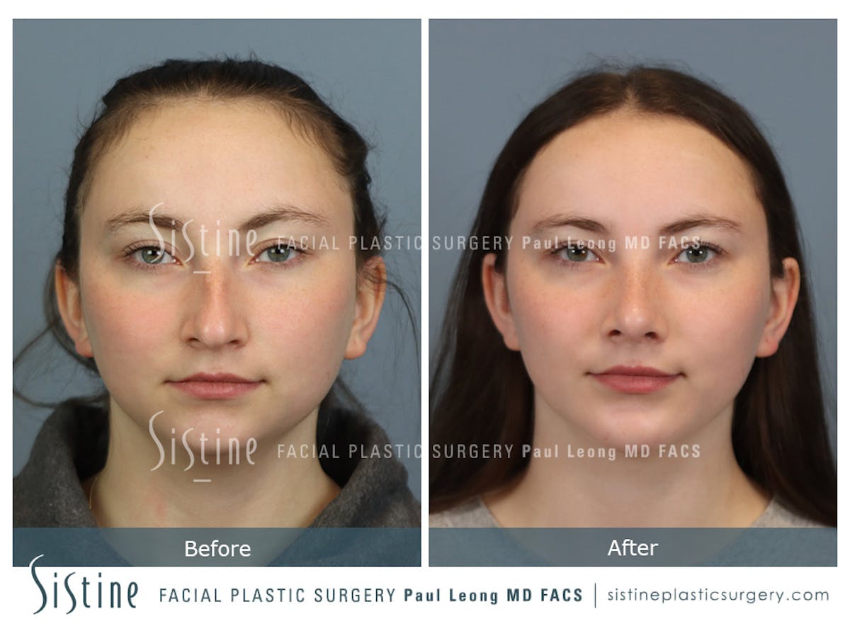 Chin Implant Before & After Gallery - Patient 116545 - Image 1