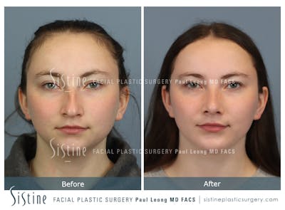Chin Implant Before & After Gallery - Patient 116545 - Image 1