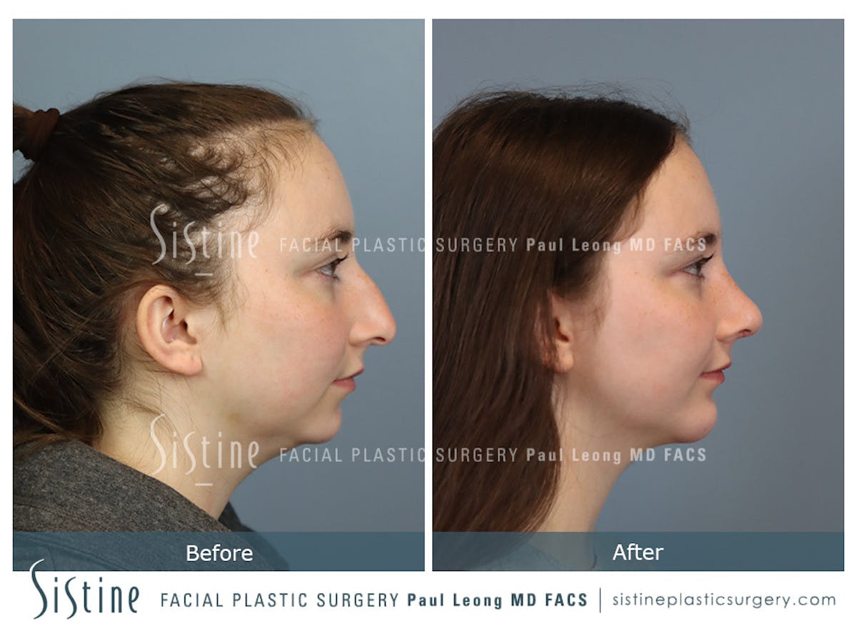 Chin Implant Before & After Gallery - Patient 116545 - Image 4