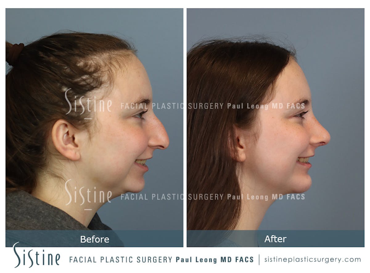 Chin Implant Before & After Gallery - Patient 116545 - Image 5