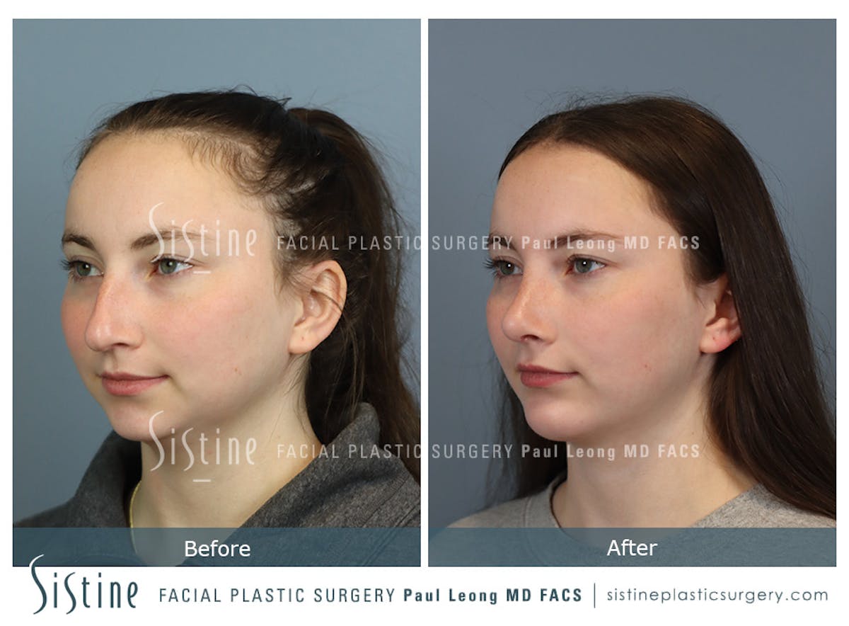 Chin Implant Before & After Gallery - Patient 116545 - Image 6
