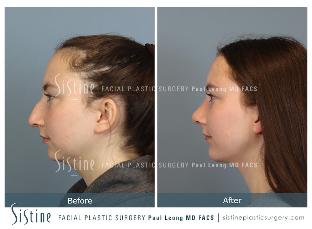Chin Implant Before & After Gallery - Patient 116545 - Image 7