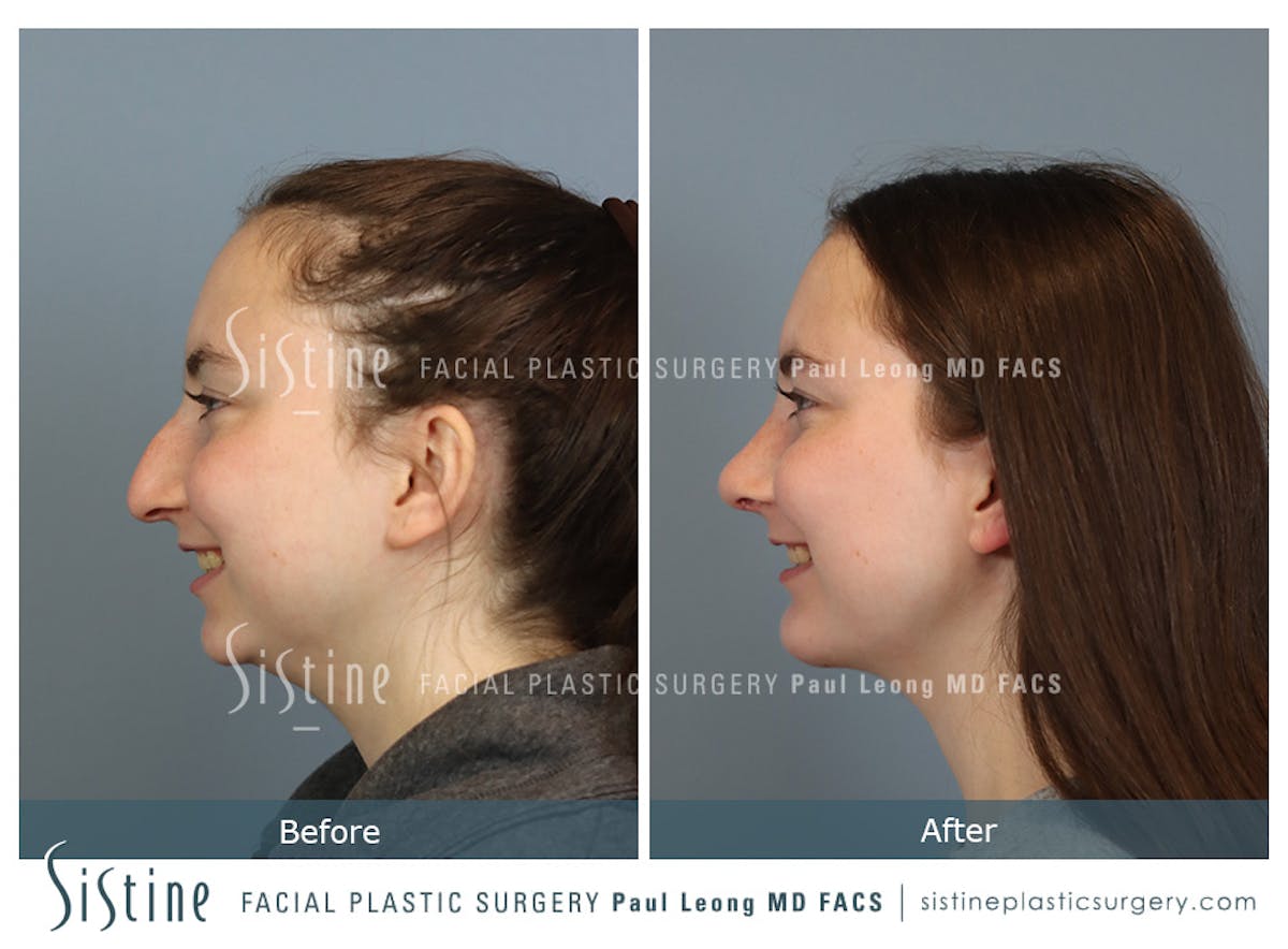 Chin Implant Before & After Gallery - Patient 116545 - Image 8